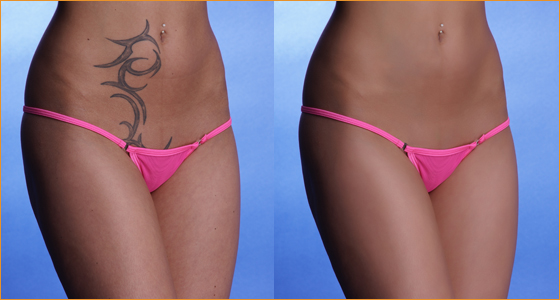 Bikini Model Retouching